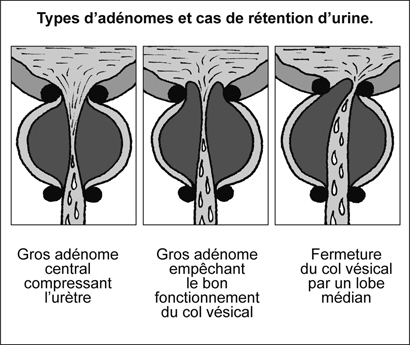 Tumeur Uretre